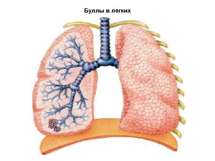 Буллы в легких картинки