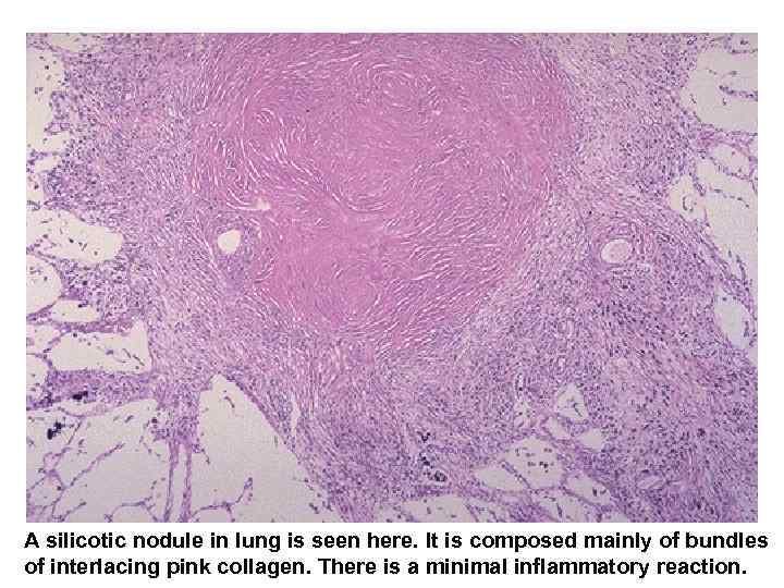  A silicotic nodule in lung is seen here. It is composed mainly of