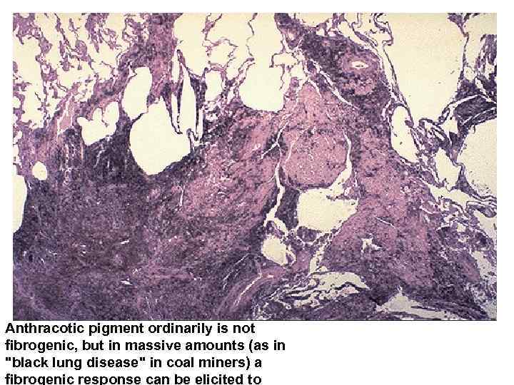 Anthracotic pigment ordinarily is not fibrogenic, but in massive amounts (as in 