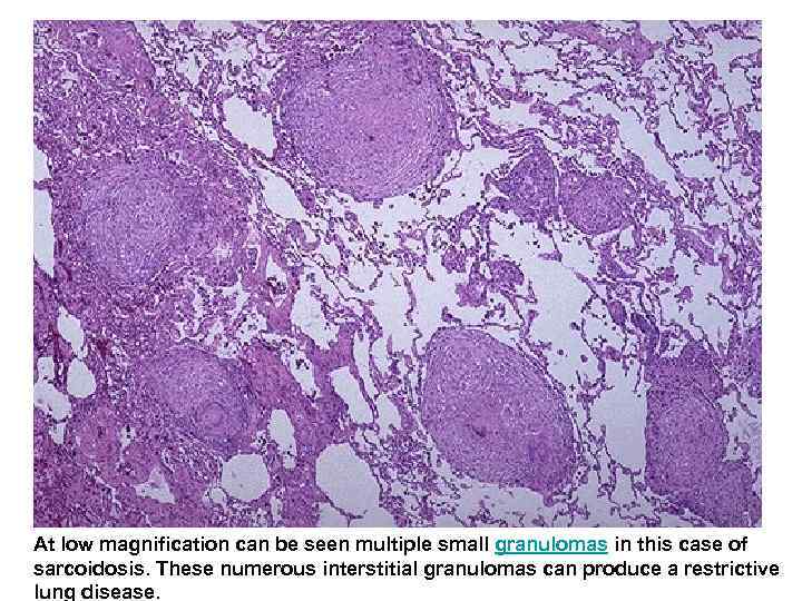  At low magnification can be seen multiple small granulomas in this case of