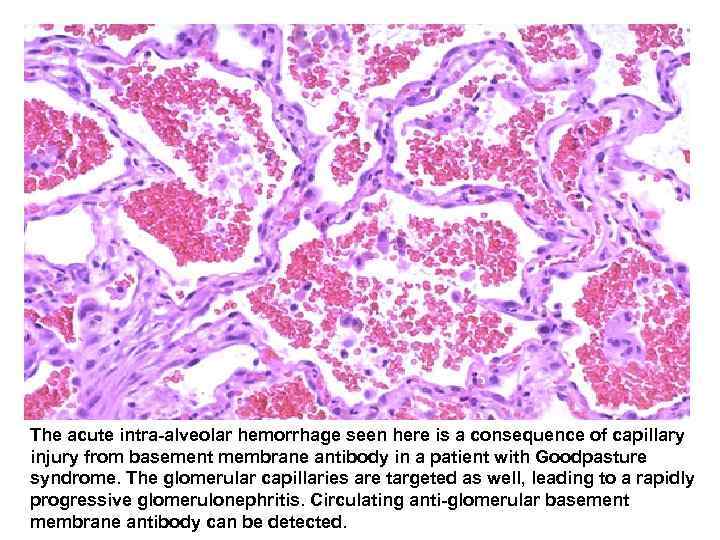  The acute intra-alveolar hemorrhage seen here is a consequence of capillary injury from