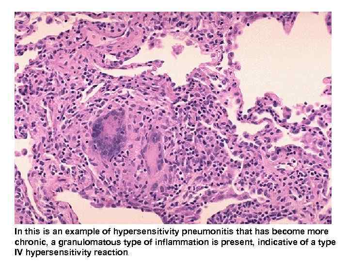  In this is an example of hypersensitivity pneumonitis that has become more chronic,