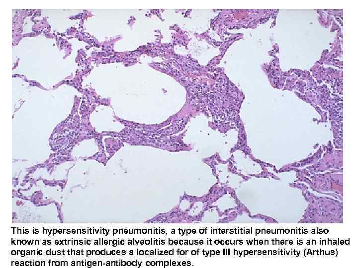 This is hypersensitivity pneumonitis, a type of interstitial pneumonitis also known as extrinsic allergic