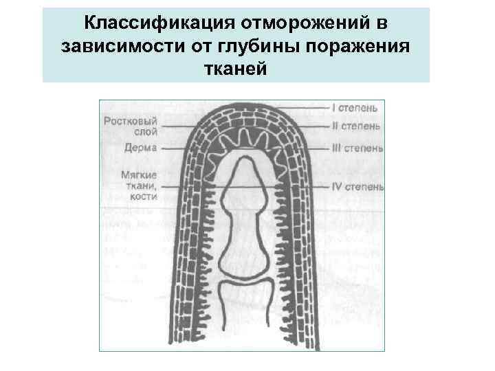 Классификация отморожений в зависимости от глубины поражения тканей 