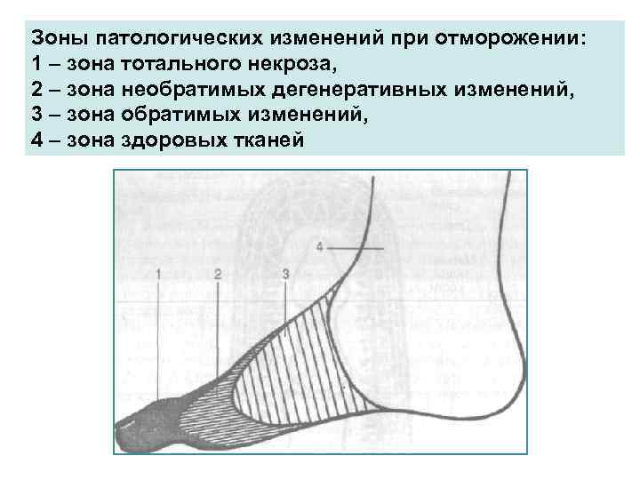 Зоны патологических изменений при отморожении: 1 – зона тотального некроза, 2 – зона необратимых