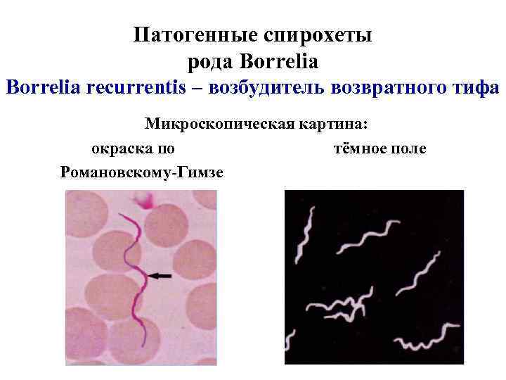 Патогенные спирохеты рода Borrelia recurrentis – возбудитель возвратного тифа Микроскопическая картина: окраска по тёмное