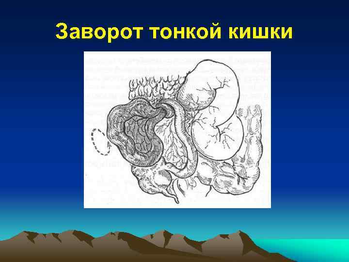 Симптомы заворота кишок. Заворот тонкого кишечника. Заворот тонкой кишки на кт.