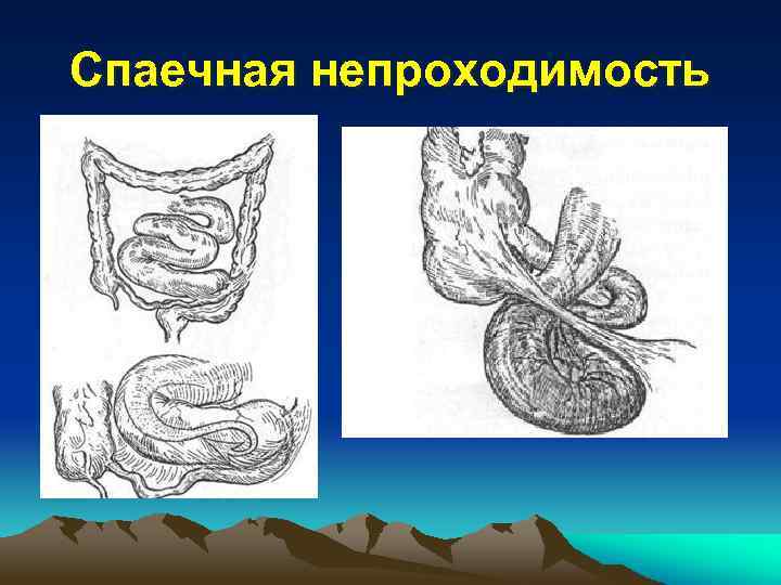 Спаечная непроходимость 