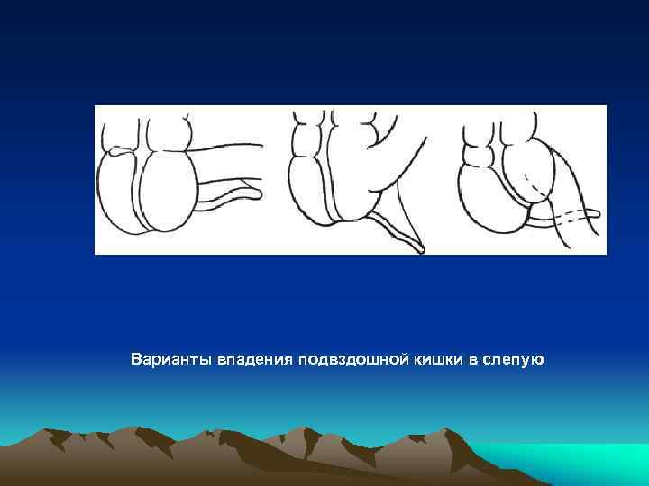 Варианты впадения подвздошной кишки в слепую 