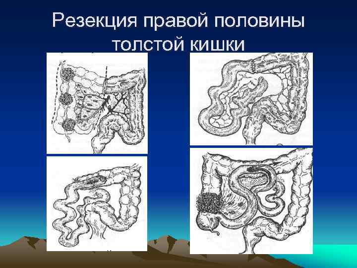 Резекция правой половины толстой кишки 