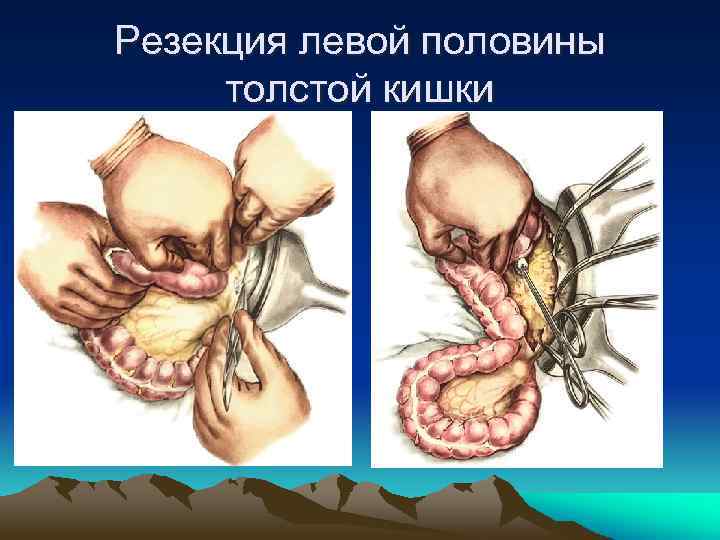 Резекция левой половины толстой кишки 