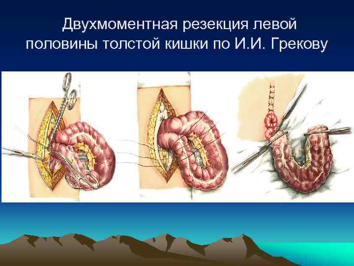  Двухмоментная резекция левой половины толстой кишки по И. И. Грекову 