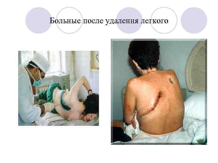 Больные после удаления легкого 