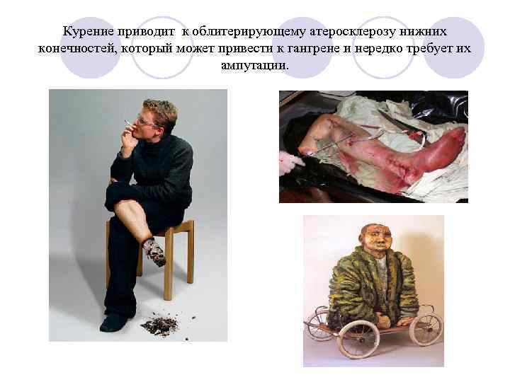 Курение приводит к облитерирующему атеросклерозу нижних конечностей, который может привести к гангрене и нередко