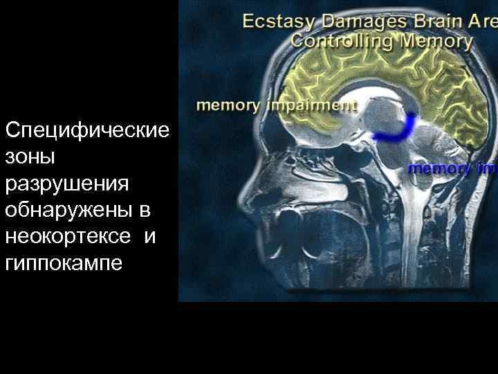Специфические зоны разрушения обнаружены в неокортексе и гиппокампе 