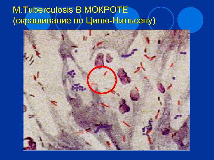 M. Tuberculosis В МОКРОТЕ (окрашивание по Цилю-Нильсену) 