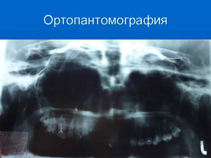Ортопантомография 