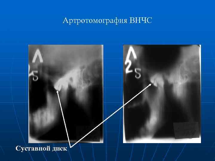 Рентгенологическая картина при хронических артритах височно нижнечелюстного сустава