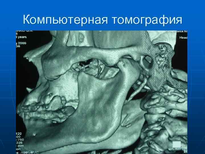 Компьютерная томография 
