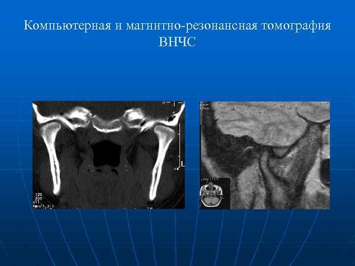 Компьютерная и магнитно-резонансная томография ВНЧС 