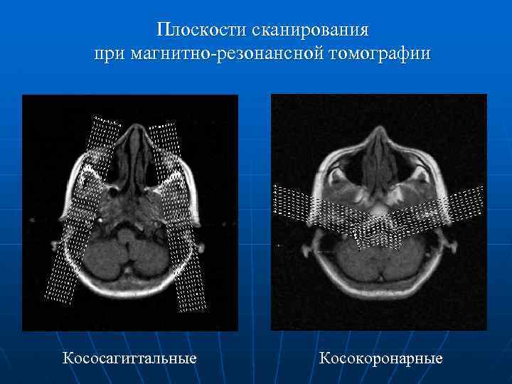 Плоскости сканирования при магнитно-резонансной томографии Кососагиттальные Косокоронарные 