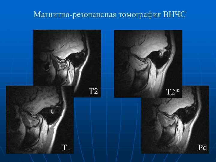 Магнитно-резонансная томография ВНЧС Т 2 Т 1 Т 2* Pd 