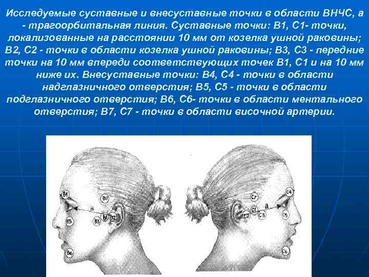 Исследуемые суставные и внесуставные точки в области ВНЧС, а - трагоорбитальная линия. Суставные точки:
