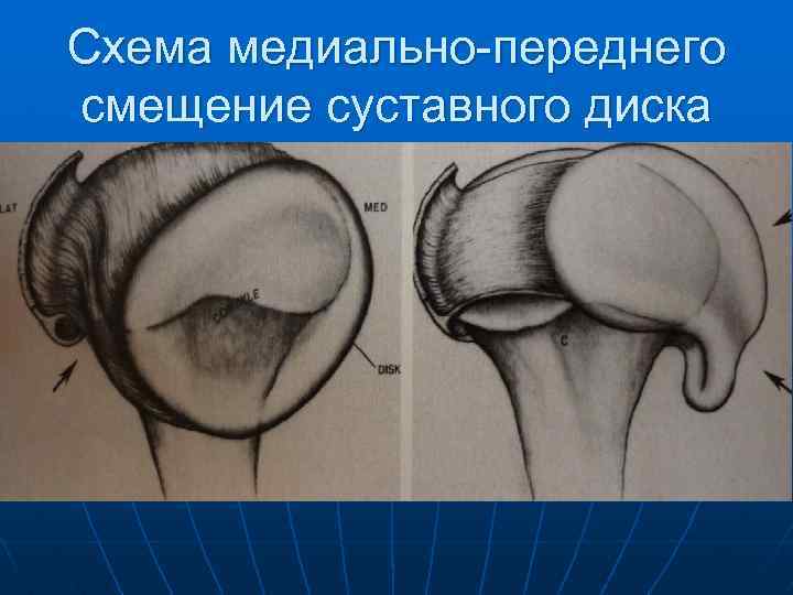 Схема медиально-переднего смещение суставного диска 