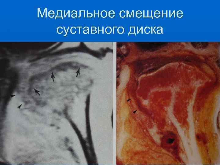 Медиальное смещение суставного диска 