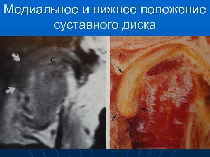 Медиальное и нижнее положение суставного диска 