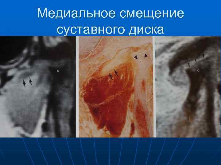 Медиальное смещение суставного диска 
