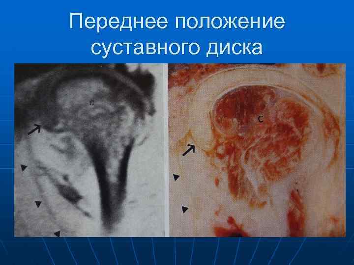 Переднее положение суставного диска 