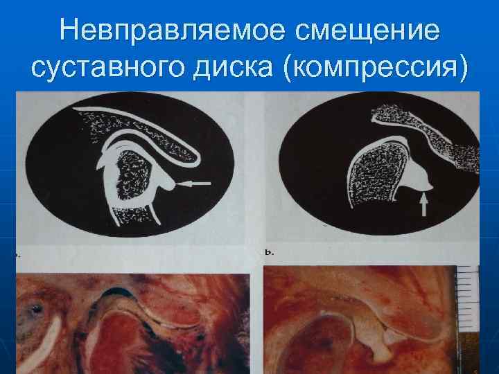 Для диагностики смещения суставного диска височно нижнечелюстного сустава внчс применяют метод