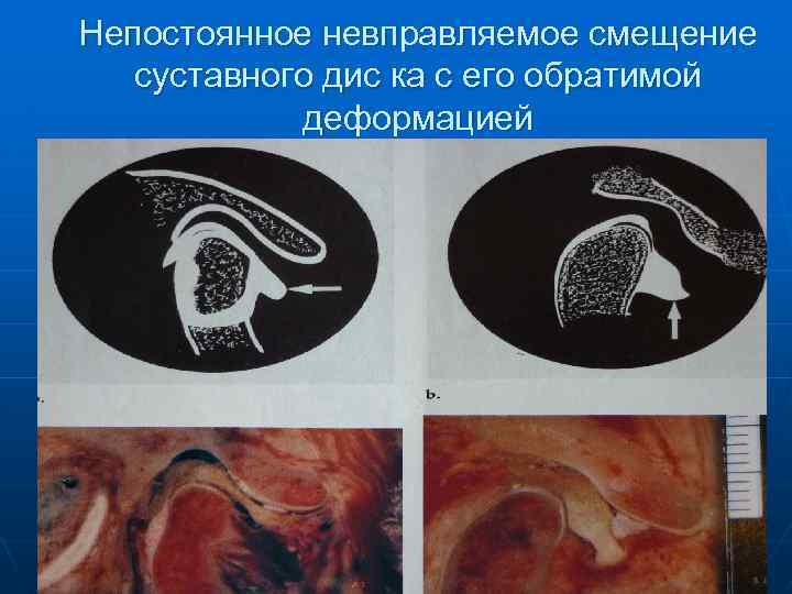 Непостоянное невправляемое смещение суставного дис ка с его обратимой деформацией 