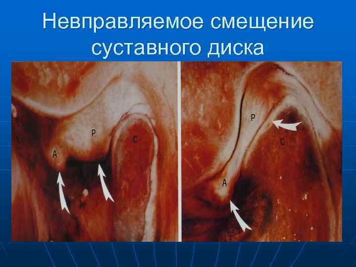 Невправляемое смещение суставного диска 
