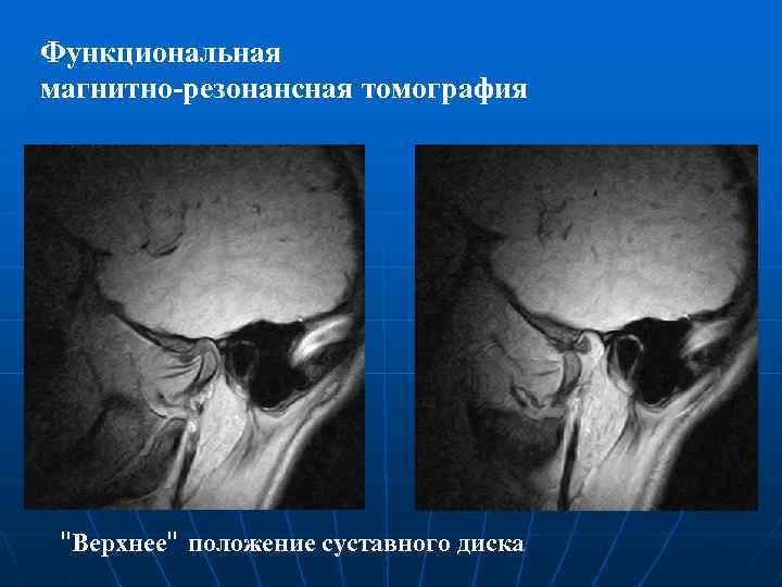 Функциональная магнитно-резонансная томография "Верхнее" положение суставного диска 