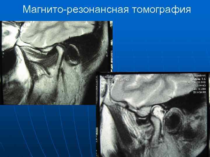 Резонансная диаграмма лопаток