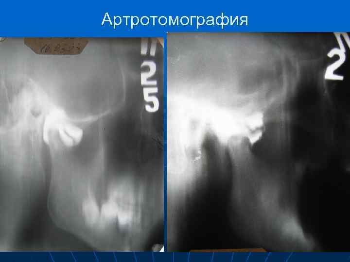 Артротомография 