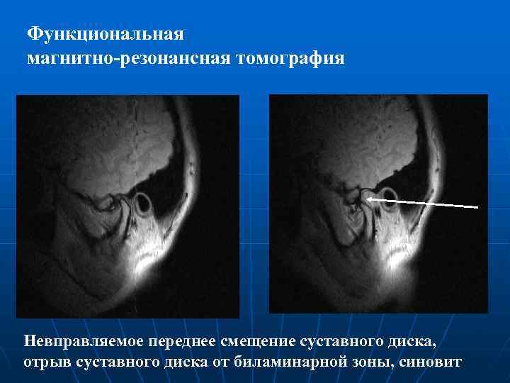 Для диагностики смещения суставного диска височно нижнечелюстного сустава внчс применяют метод