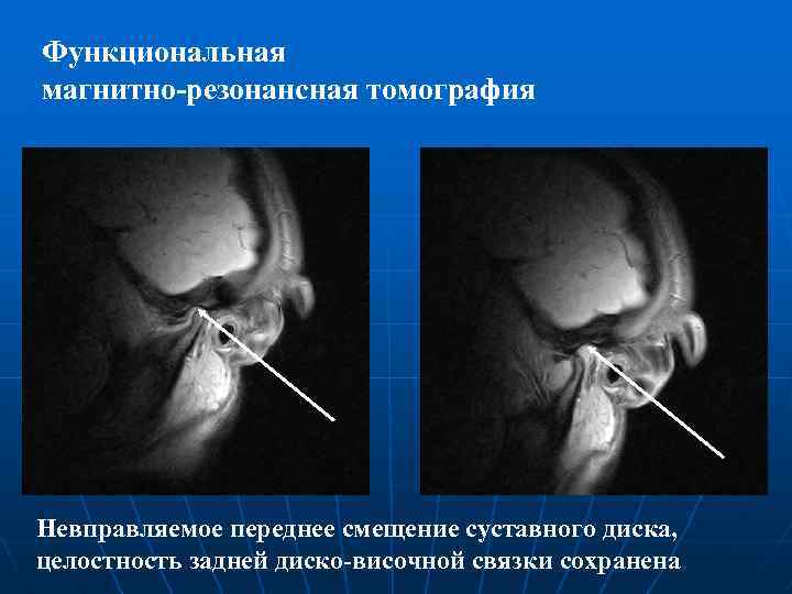 Функциональная магнитно-резонансная томография Невправляемое переднее смещение суставного диска, целостность задней диско-височной связки сохранена 