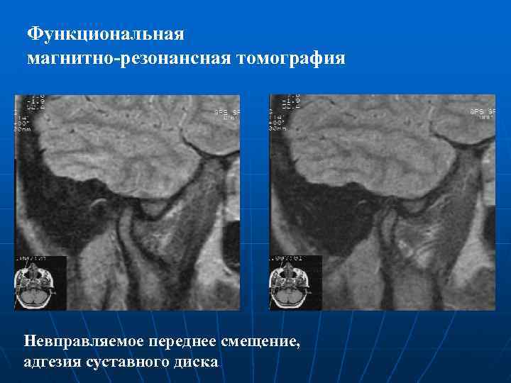 Функциональная магнитно-резонансная томография Невправляемое переднее смещение, адгезия суставного диска 