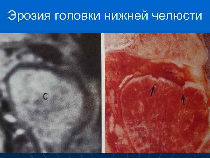 Эрозия головки нижней челюсти 