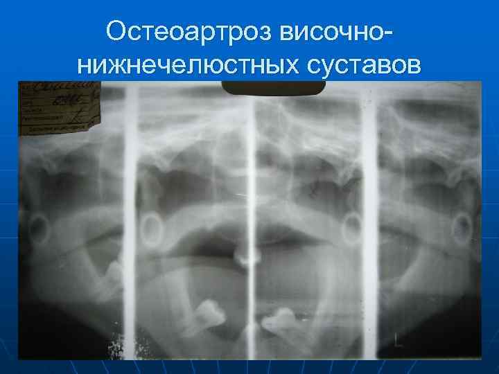 Остеоартроз височнонижнечелюстных суставов 