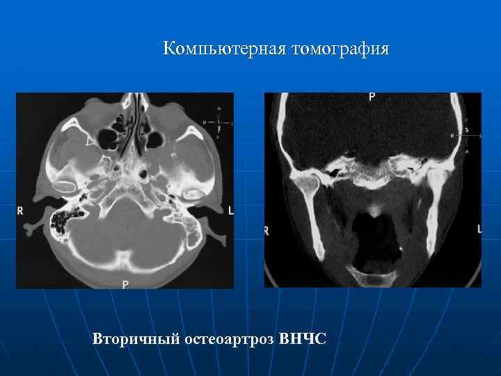 Рентгенологическая картина при хронических артритах височно нижнечелюстного сустава