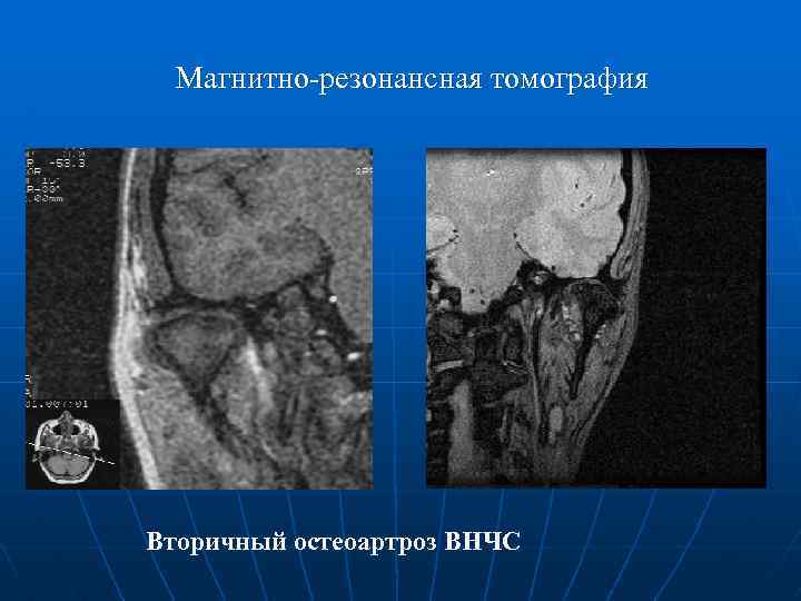 Магнитно-резонансная томография Вторичный остеоартроз ВНЧС 