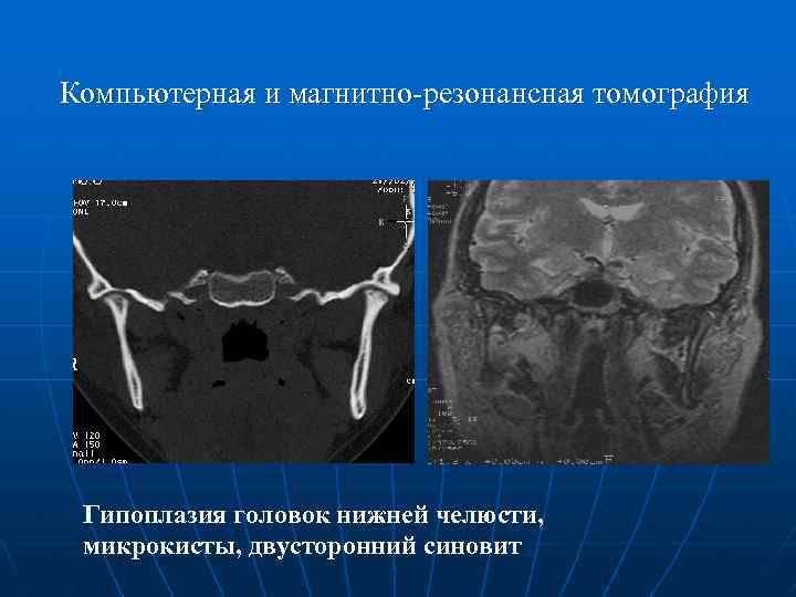 Компьютерная томография тазобедренного сустава что показывает