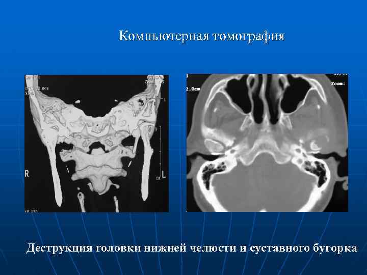 Компьютерная томография Деструкция головки нижней челюсти и суставного бугорка 