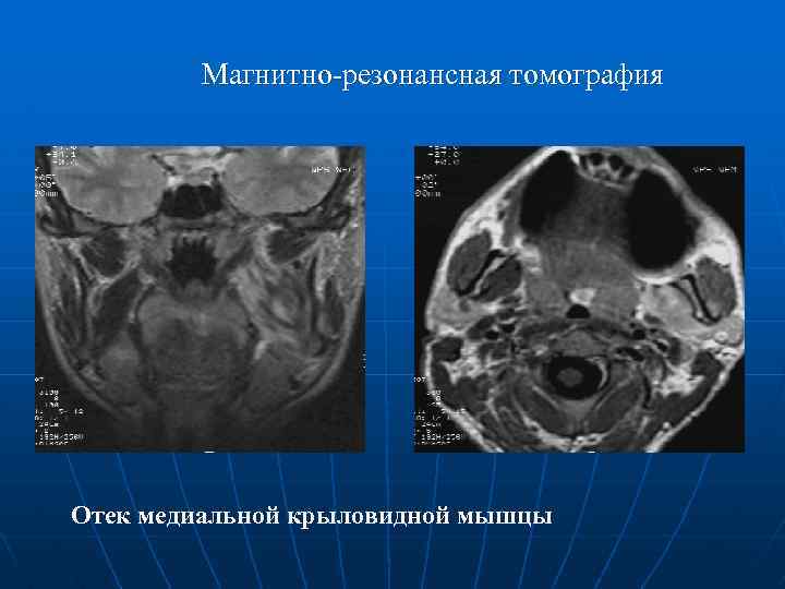 Магнитно-резонансная томография Отек медиальной крыловидной мышцы 