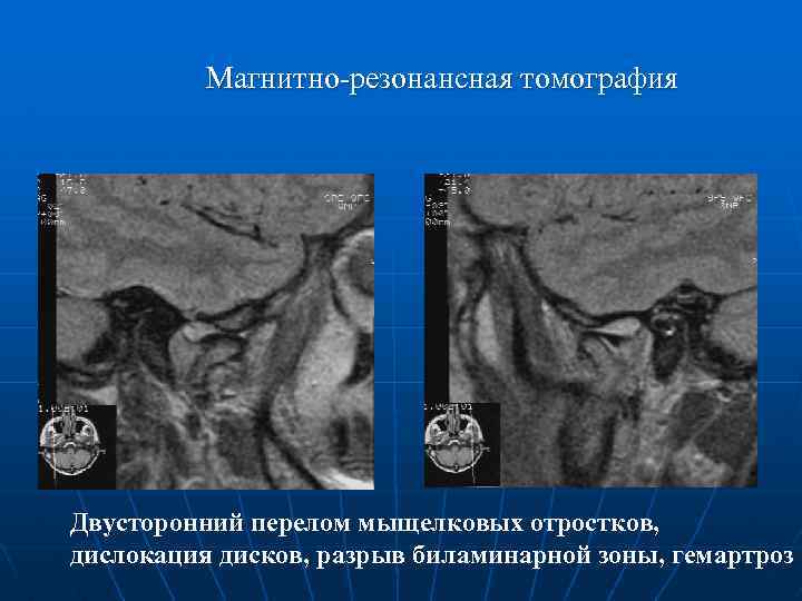 Магнитно-резонансная томография Двусторонний перелом мыщелковых отростков, дислокация дисков, разрыв биламинарной зоны, гемартроз 