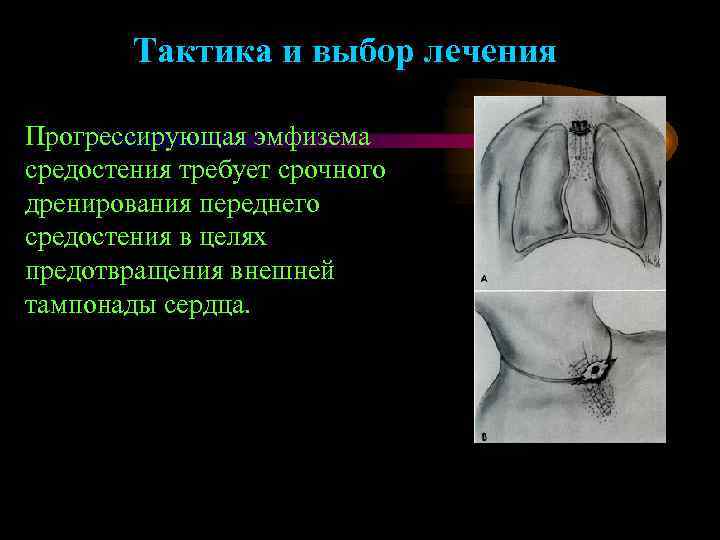 Тактика и выбор лечения Прогрессирующая эмфизема средостения требует срочного дренирования переднего средостения в целях